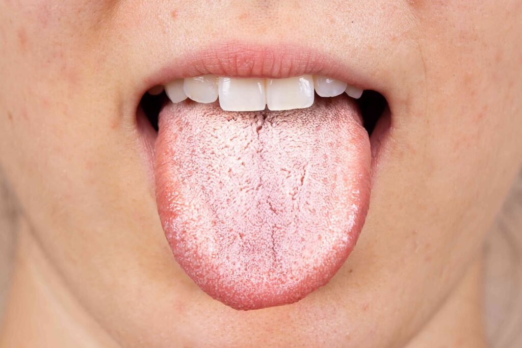 Thrush (Oral Candidiasis) Symptoms in Adults and Children