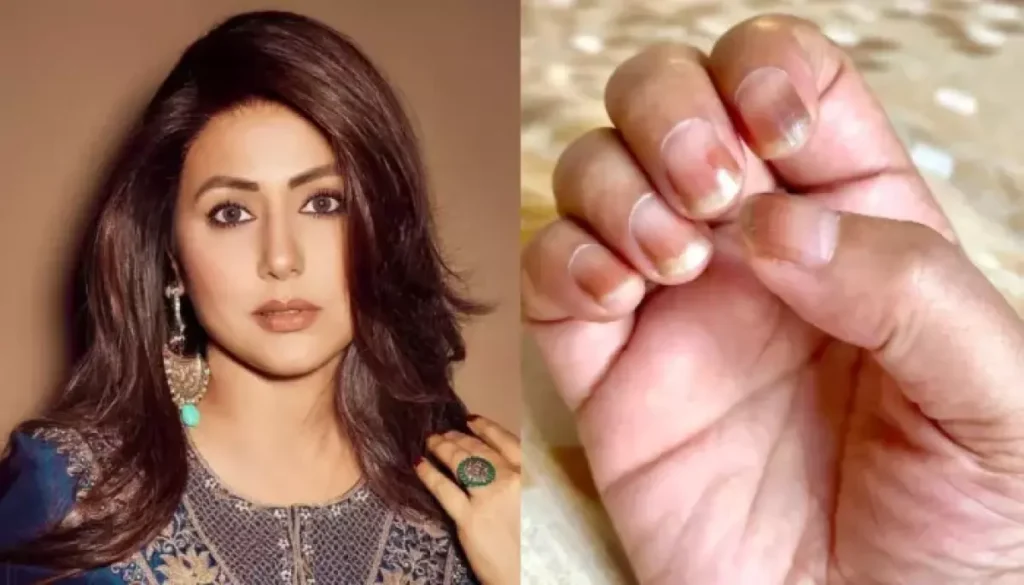 Hina Khan Resolves Mystery About Dis-coloured Nails, Replies To People’s Queries, ‘How Can I Pray..’