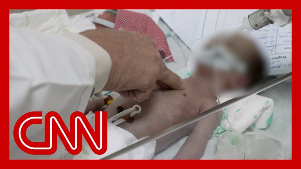 Doctor in Afghanistan brings malnourished baby back from the brink of death