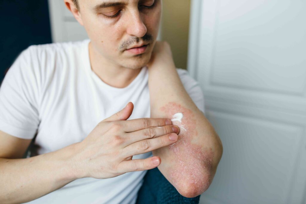 Effective Eczema Treatment: Topical and Oral Options