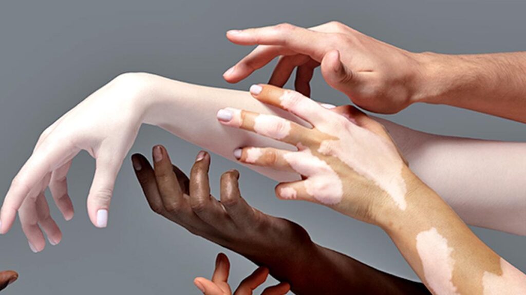 No health without skin health: a global call to end skin bleaching and prioritise dermatological equity