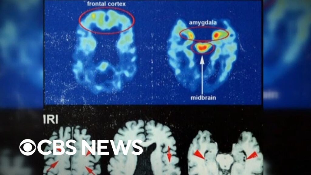 Football players report they believe they have CTE for study