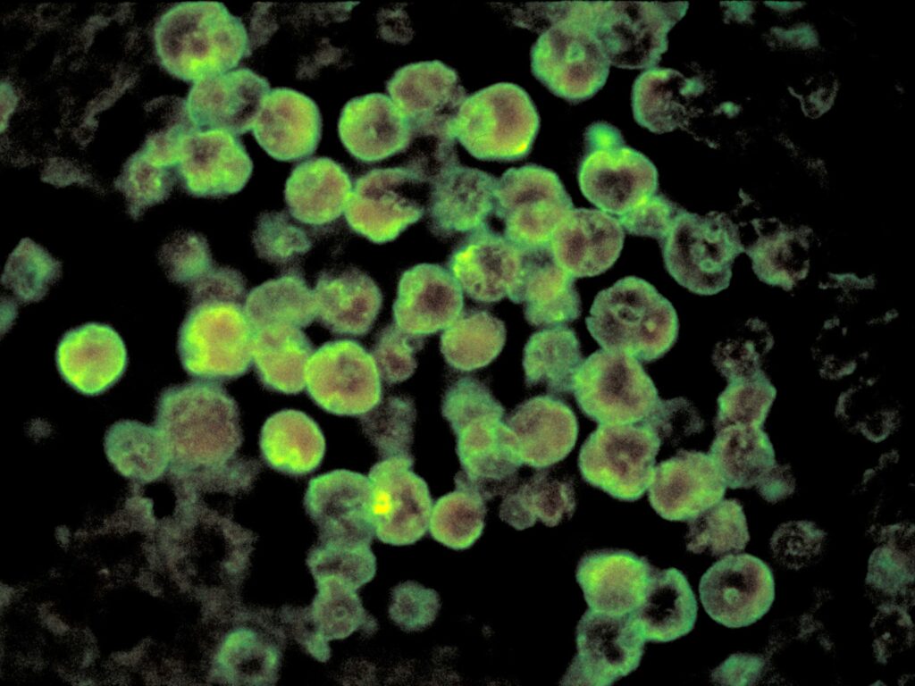 Alarm in India’s Kerala as cases of ‘brain-eating’ amoeba rise | Health News
